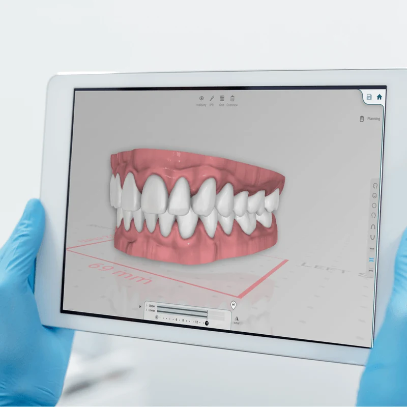 3D digital dental scan reviewed on a tablet, modern chairside imaging at Advanced Dental Care