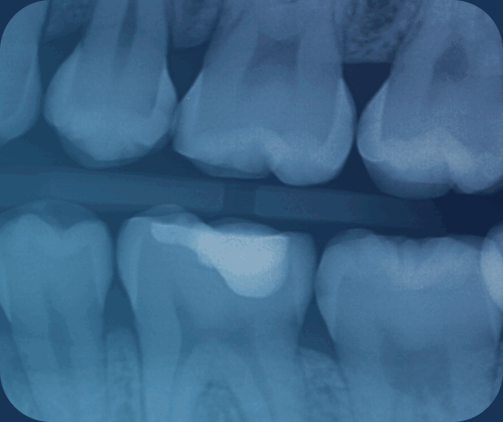 Bitewing X-ray reviewed by Pearl AI at Advanced Dental Care in Provo, Utah, algorithmic second read