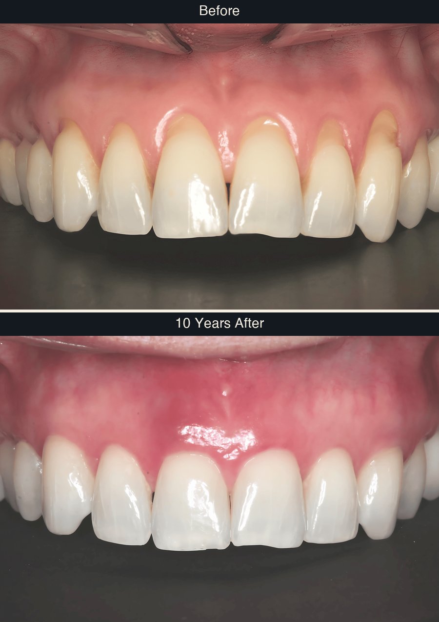 Gum recession before and 10 years after Pinhole treatment