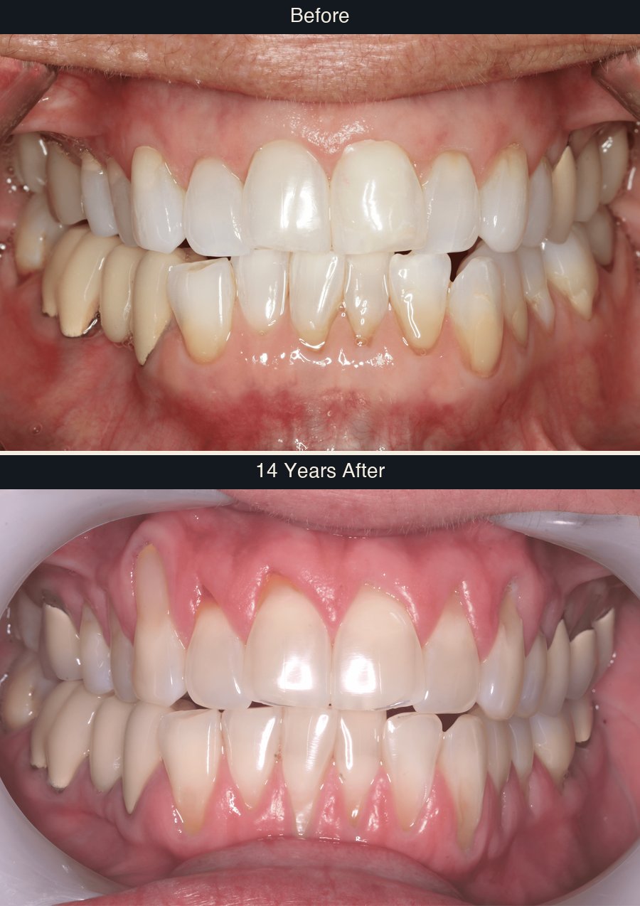 Gum recession before and 14 years after Pinhole treatment