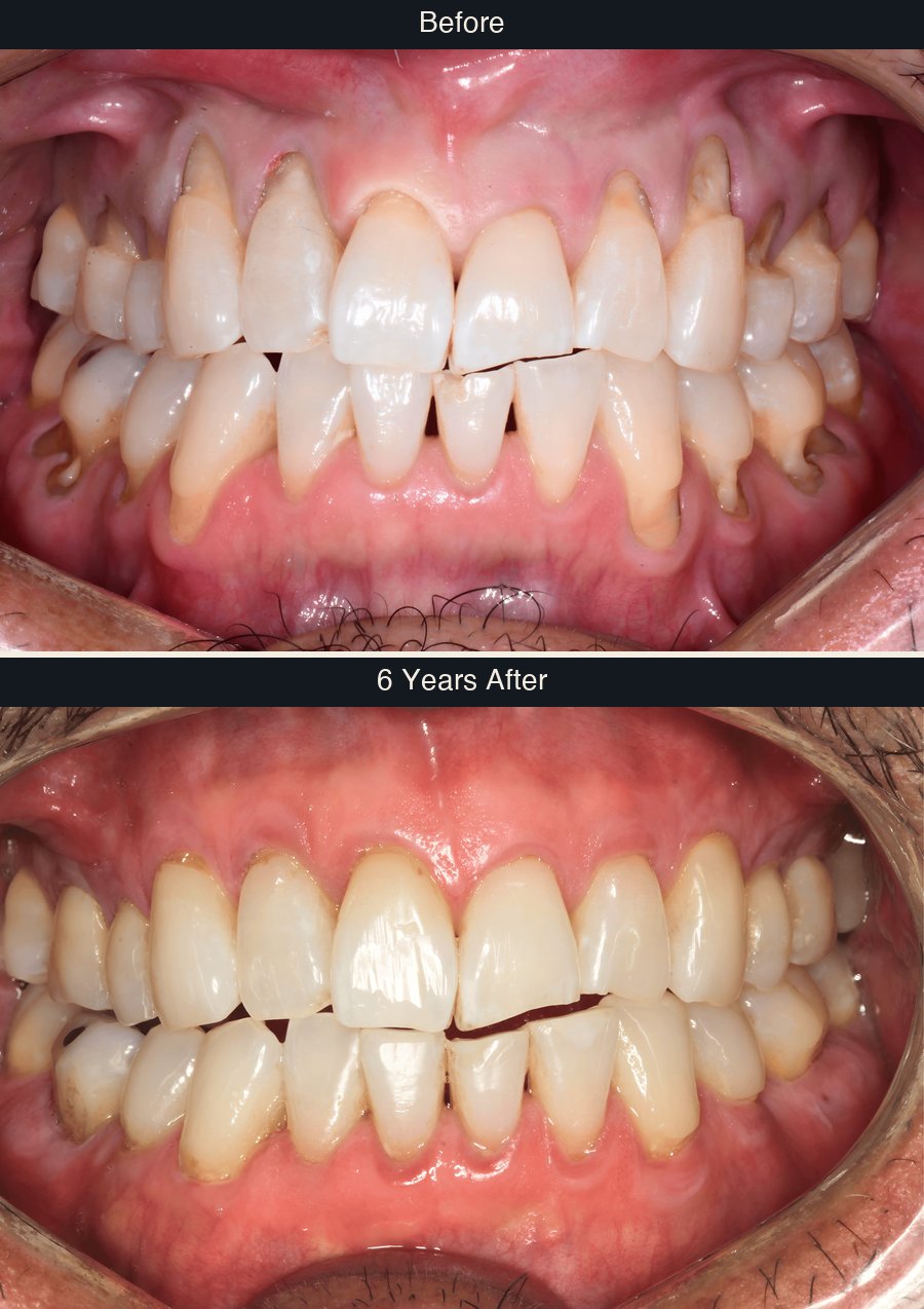 Gum recession before and 6 years after Pinhole treatment